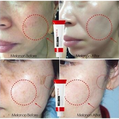 Alternative view of MEDI-PEEL Melanon X Cream brightening face cream against pigmentation