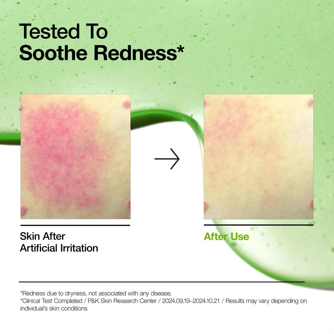 Anua_Azelaic_Acid_10_Hyaluron_Redness_Soothing_Serum__5_-8f87e5f86d37c3540d6aa77cd0251e10